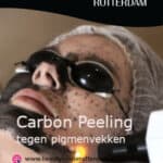 Persoon krijgt Carbon Peeling behandeling voor huidverbetering.