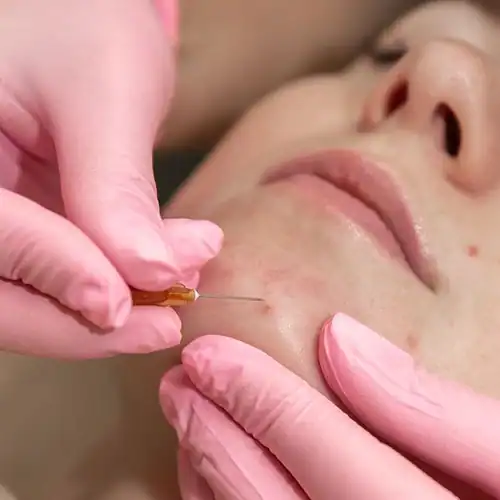 Acne behandeling
