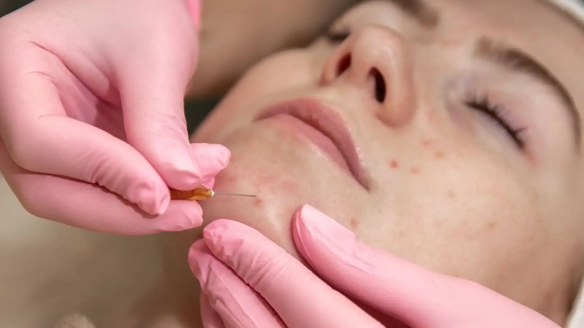 Acne behandeling bij Beautyhouse Rotterdam