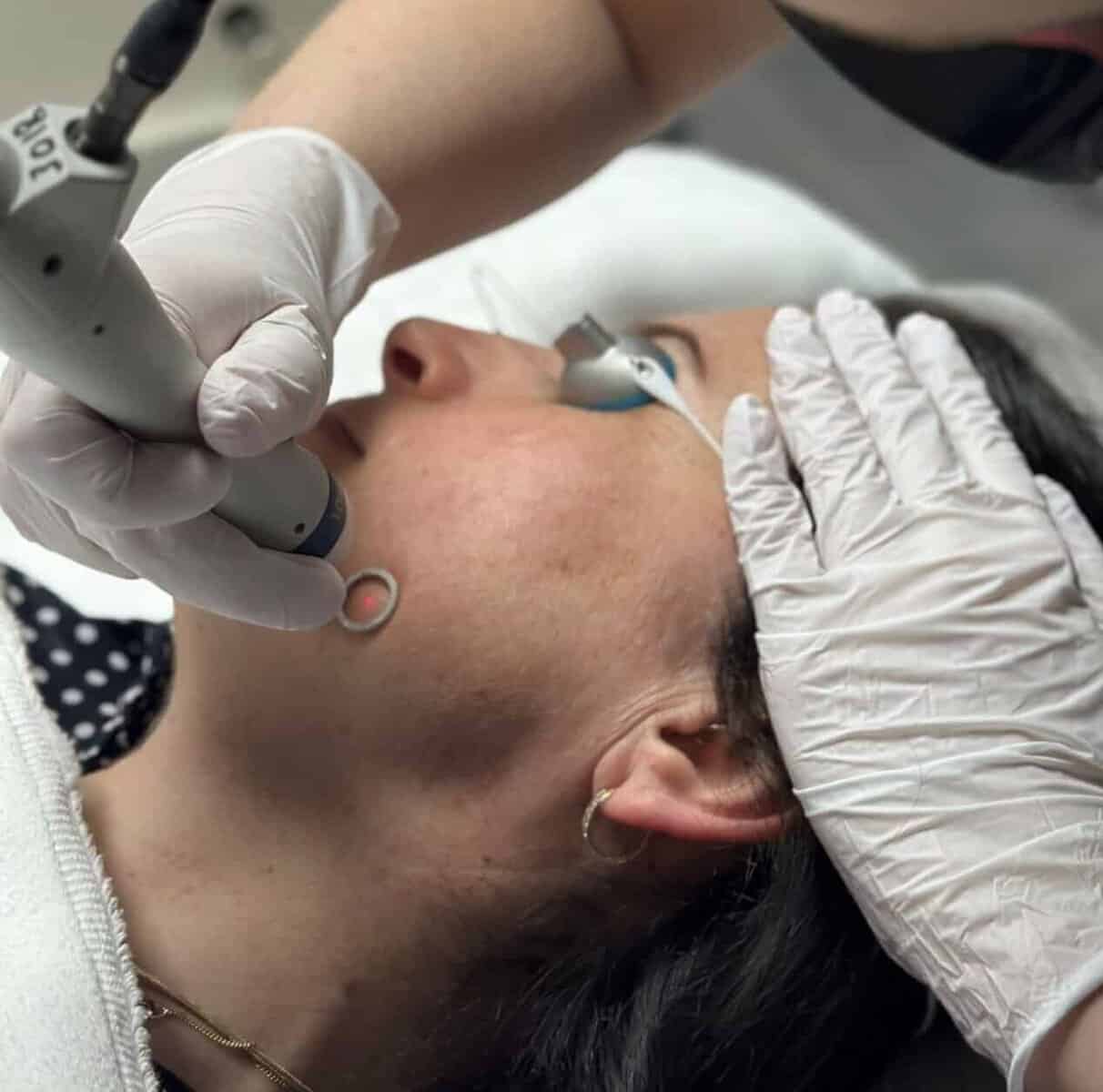 Actie Pigmentvlekken behandeling - Beautyhouse Rotterdam