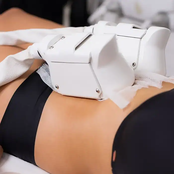 Cryolipolyse 1 zone AKTIE — Beautyhouse Rotterdam