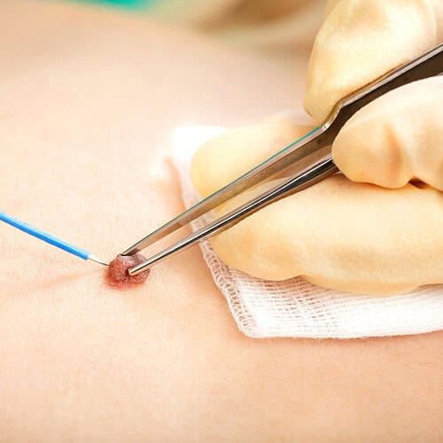 Fibromen verwijderen