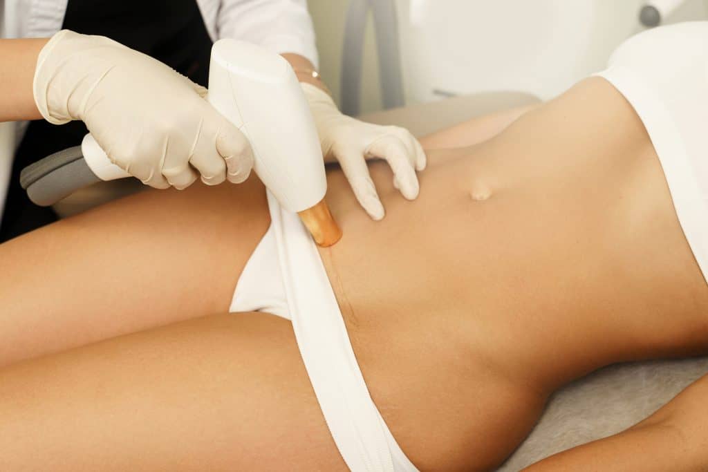 IPL- brazilian vrouw bij Beautyhouse Rotterdam