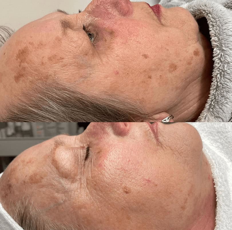 IPL Pigmentvlekken bij Beautyhouse Rotterdam