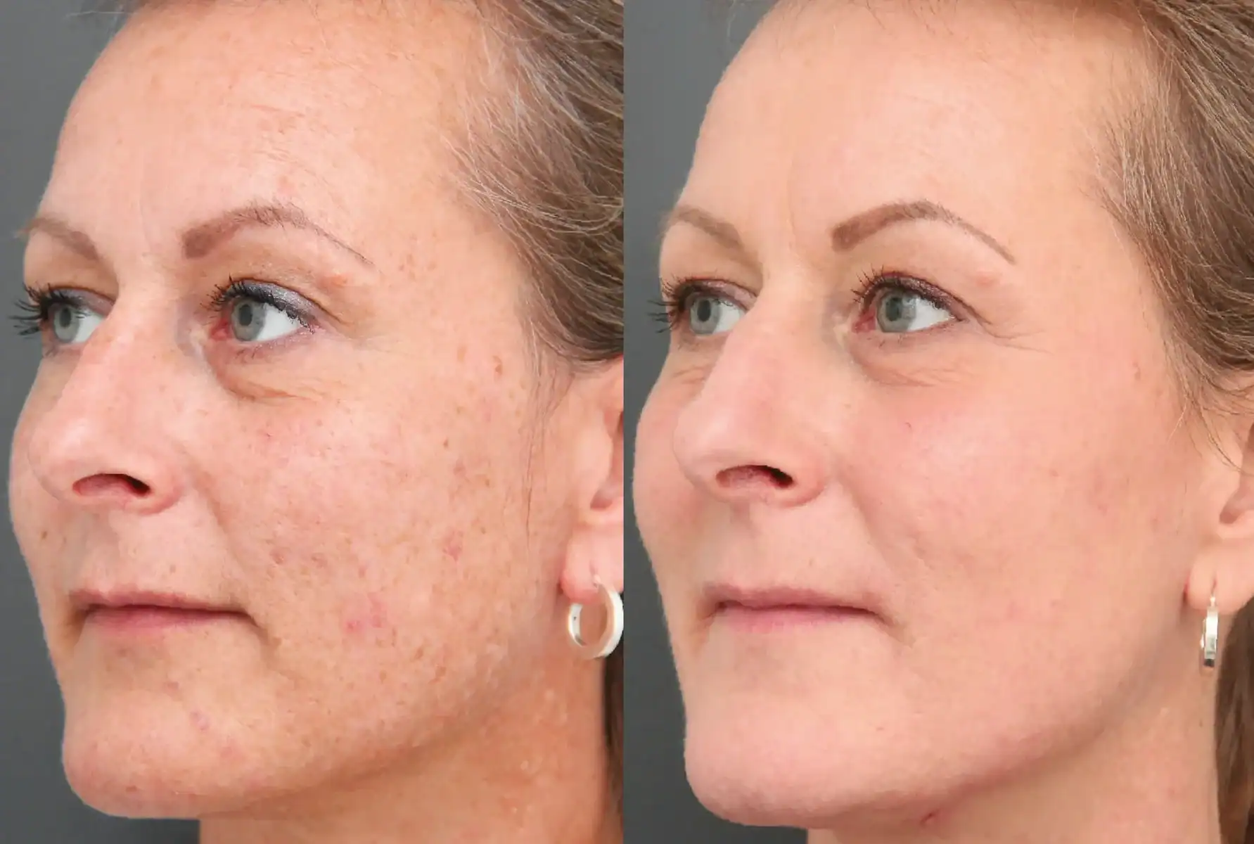 IPL huid verjonging bij Beautyhouse Rotterdam