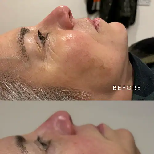 Intake natural facelift