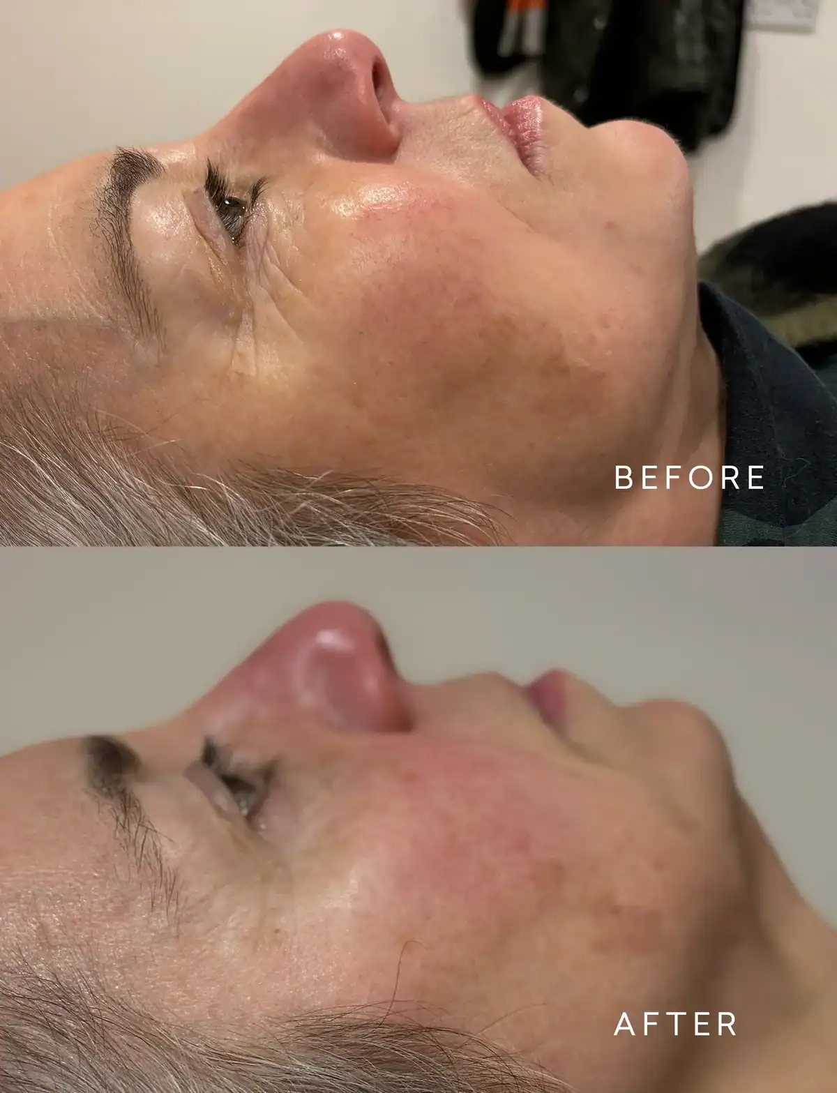 Intake natural facelift bij Beautyhouse Rotterdam