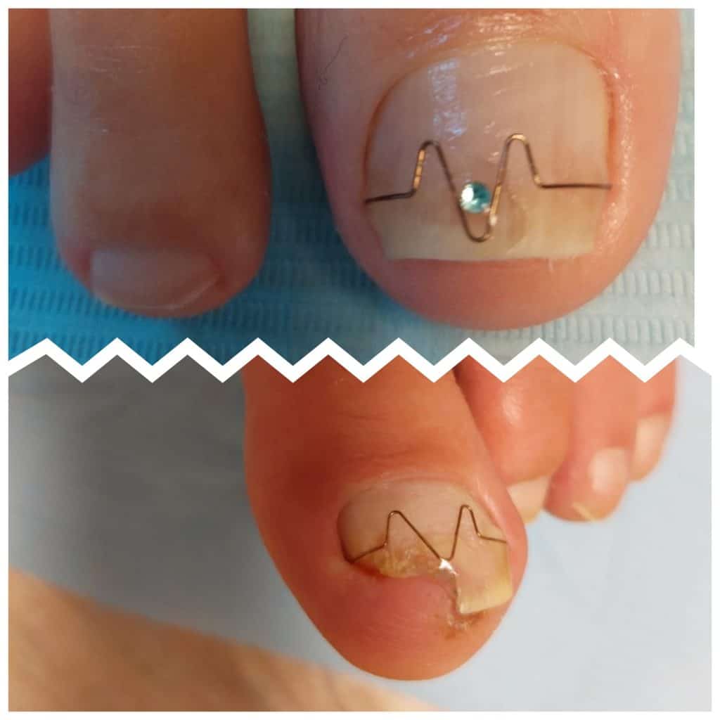 Pedicure ingegroeide nagel (nagelbeugel) bij Beautyhouse Rotterdam