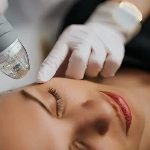 RF microneedling met EXOSOMEN
