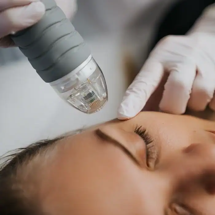RF microneedling met EXOSOMEN — Beautyhouse Rotterdam