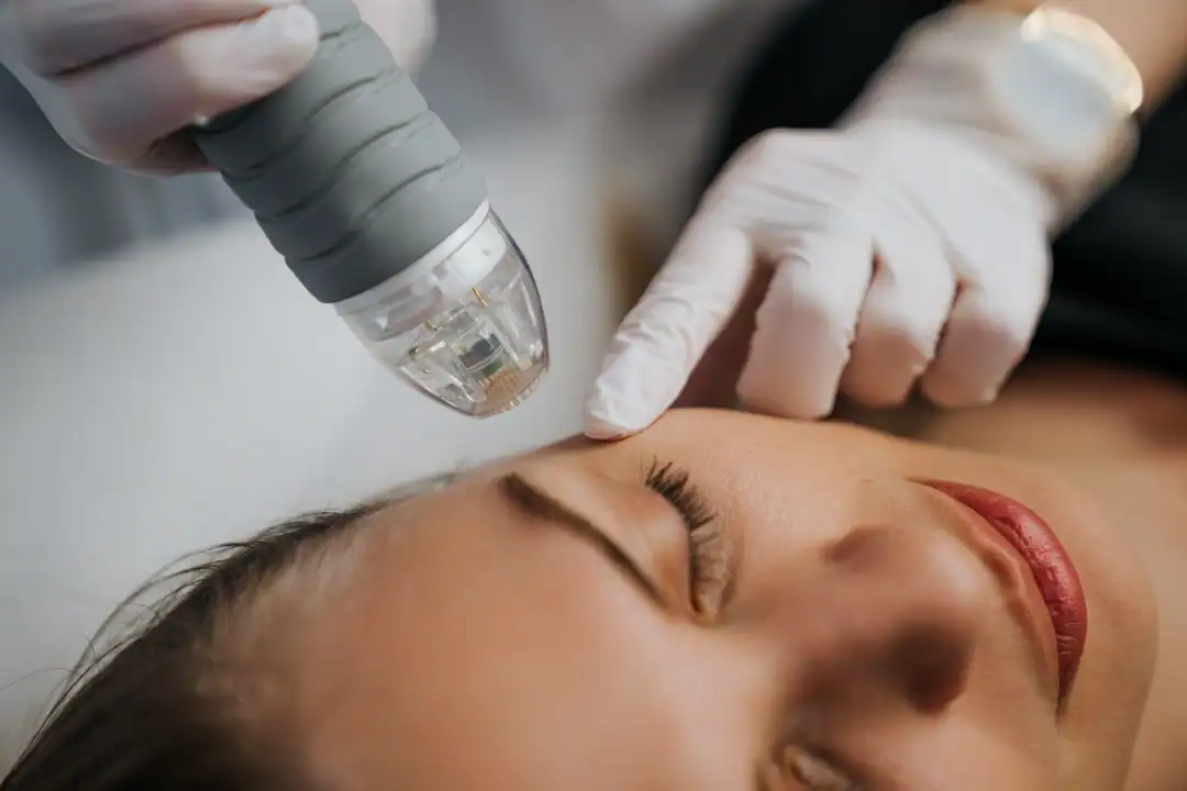 RF microneedling met EXOSOMEN bij Beautyhouse Rotterdam