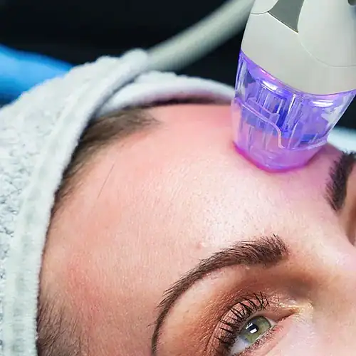 RF microneedling therapie