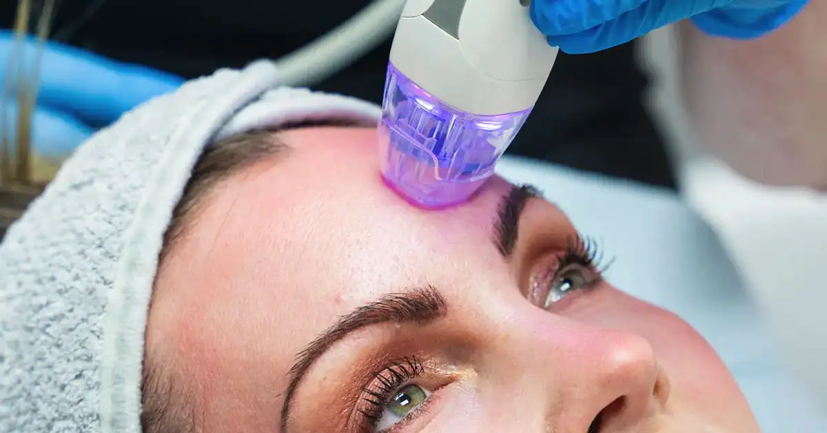 RF Microneedling bij Beauty House Rotterdam