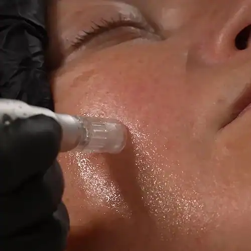 Microneedling behandeling: 6 bewezen voordelen voor je huid