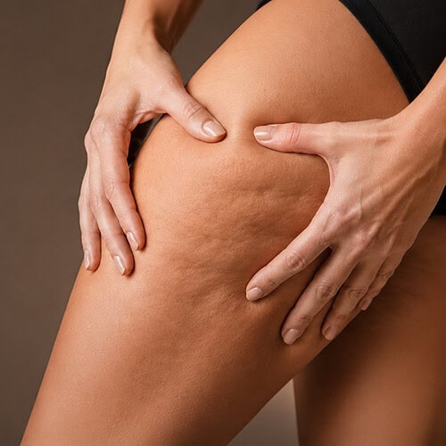 bodyslimming cellulitis benen