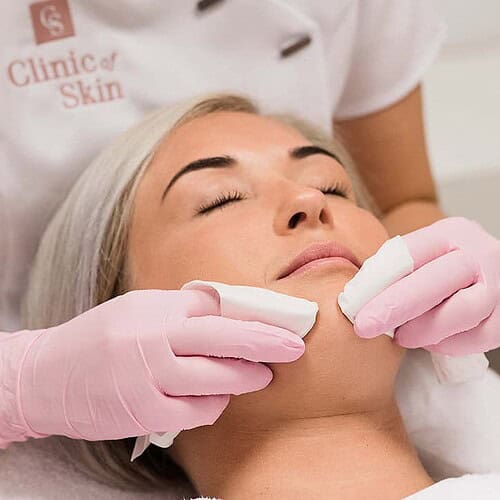 Acnebehandeling - Beautyhouse Rotterdam
