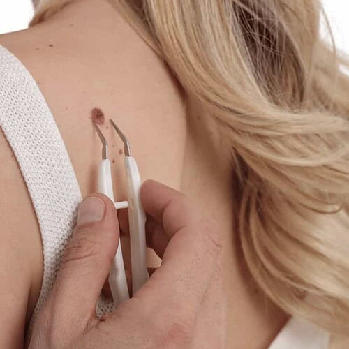 verwijdering van steelwratjes - Beautyhouse Rotterdam